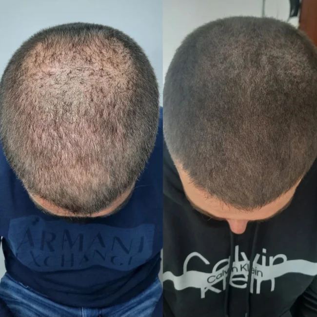 Micropigmentacion capilar