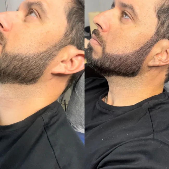 Micropigmentacion capilar